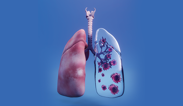 Akciğer Kanserinde Erken Teşhis ve Tedavinin Önemi
