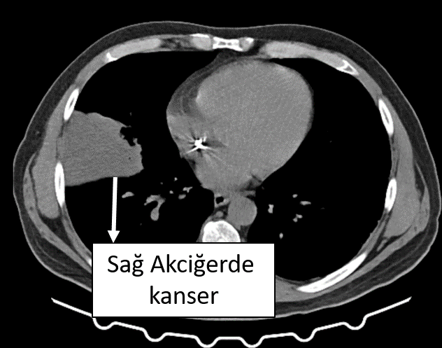 akciger-kanseri-erken-teshis