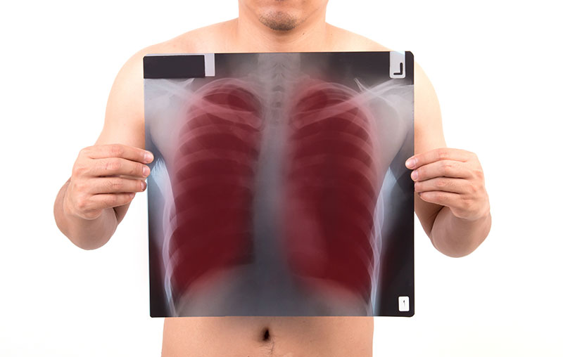 Akciğer Kanseri Tarama Programı 